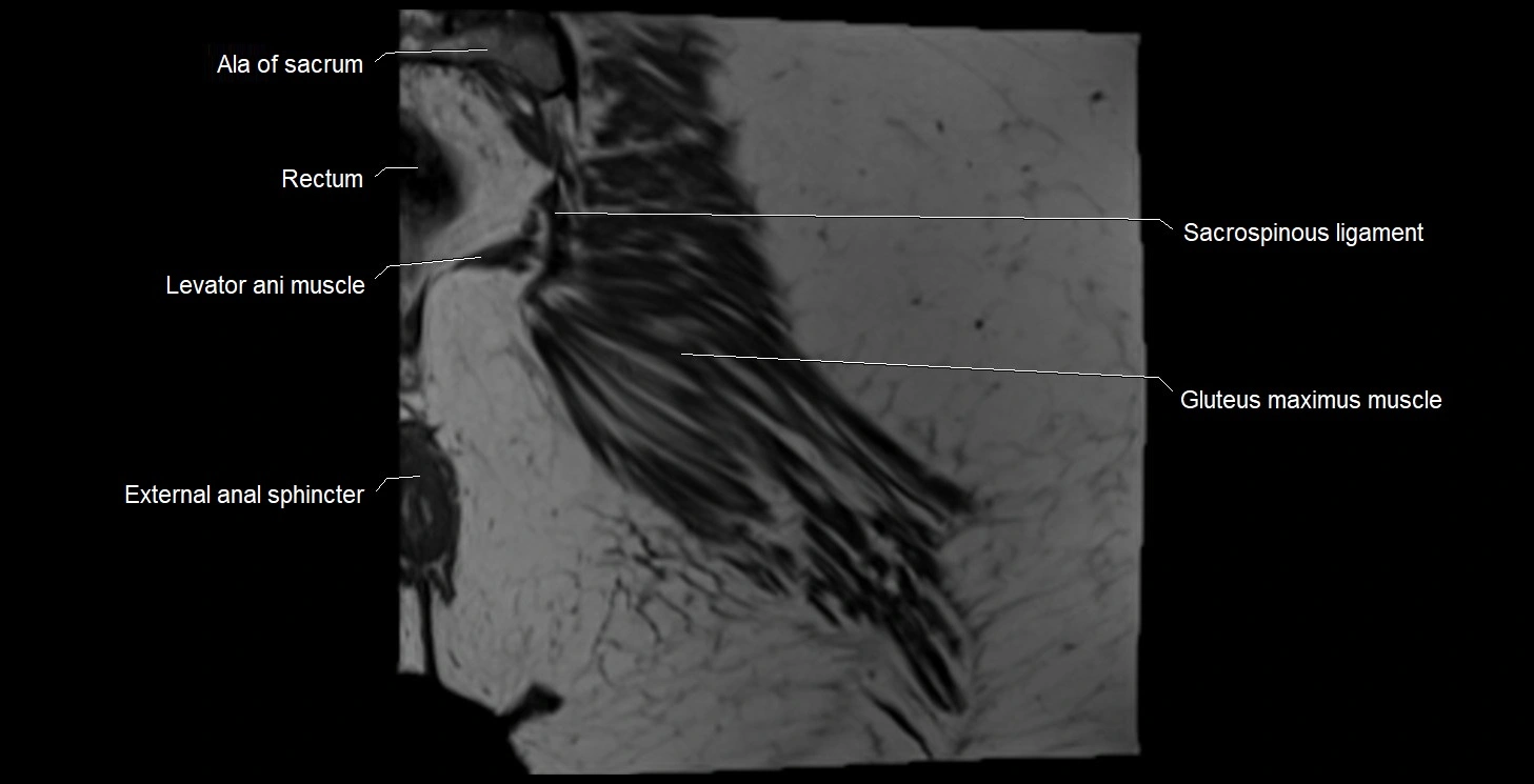 MRI Hip 3T coronal cross sectional anatomy image 61.webp
